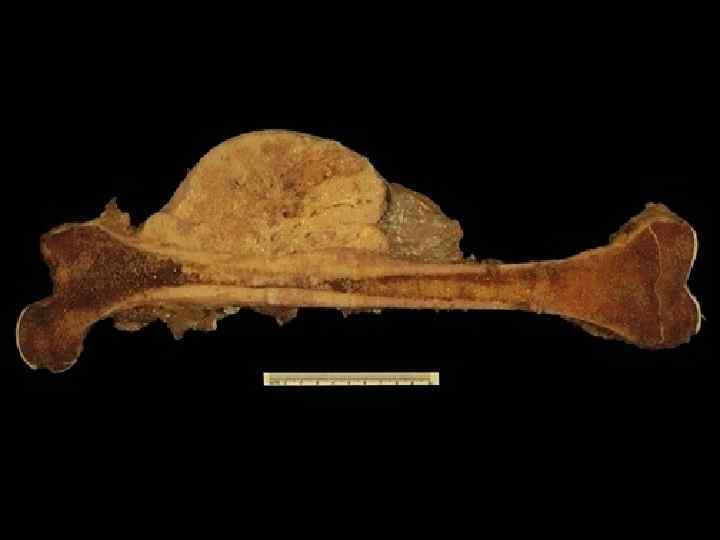 Here is an osteosarcoma of bone. The large, bulky mass arises in the cortex