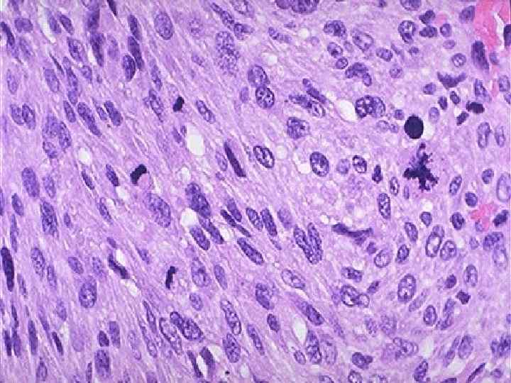 This sarcoma has many mitoses. A very large abnormal mitotic figure is seen at