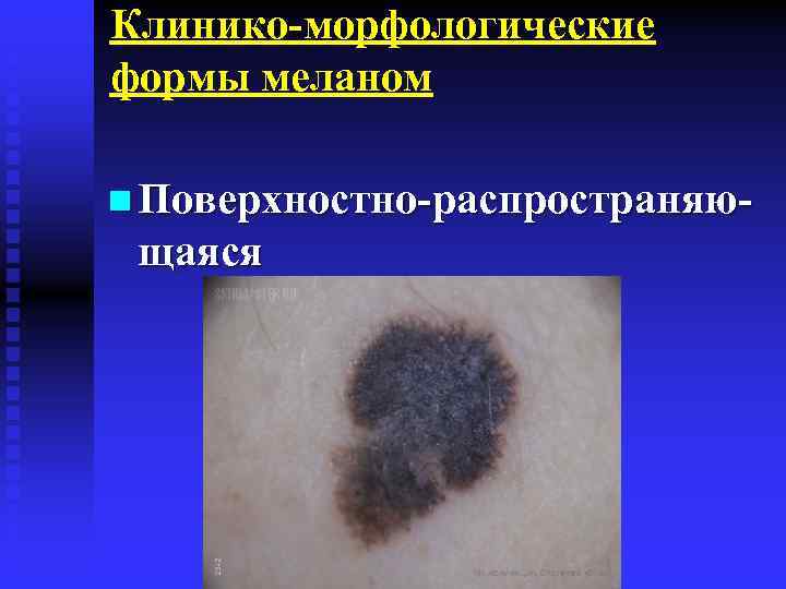 Клинико-морфологические формы меланом n Поверхностно-распространяю- щаяся 