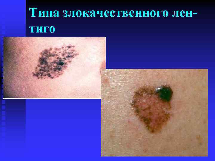 Типа злокачественного лентиго 