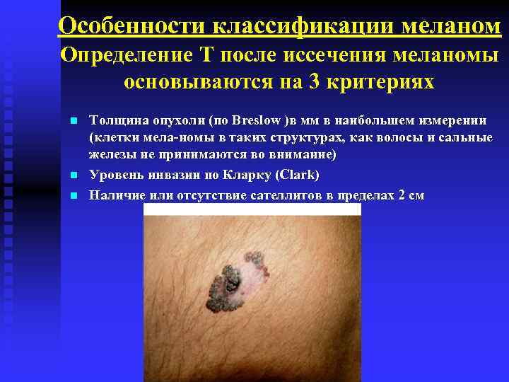 Особенности классификации меланом Определение T после иссечения меланомы основываются на 3 критериях n n