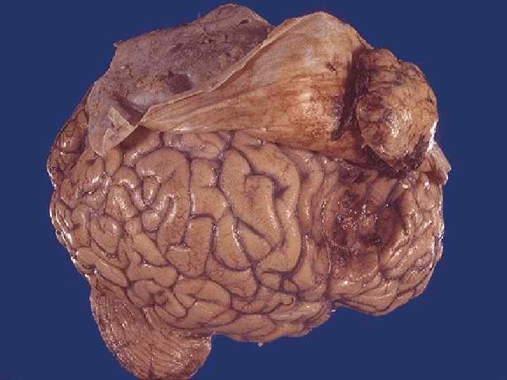  Note how this meningioma beneath the dura has compressed the underlying cerebral hemisphere.