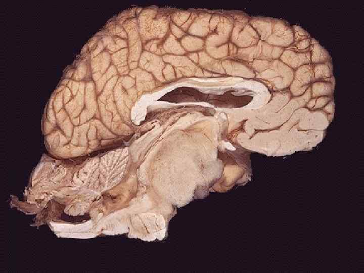 This sagittal section of brain demonstrates a large brainstem glioma. Most gliomas are astrocytomas.