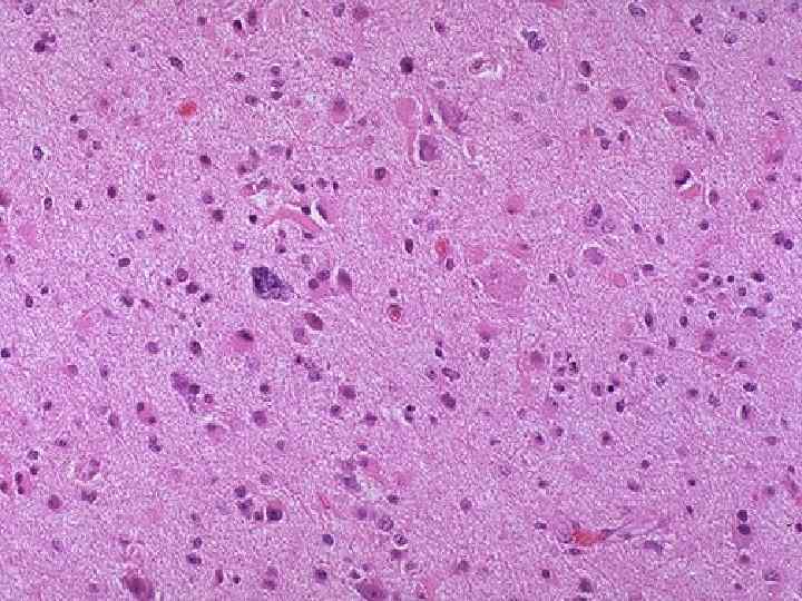 This astrocytoma demonstrates increased cellularity and pleomorphism, as compared to normal brain. Note the