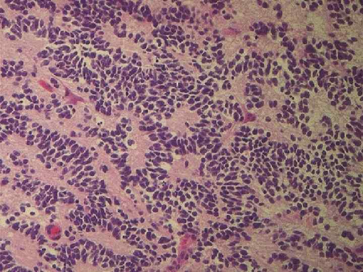 Here is the microscopic appearance of a medulloblastoma with small round blue cells. 