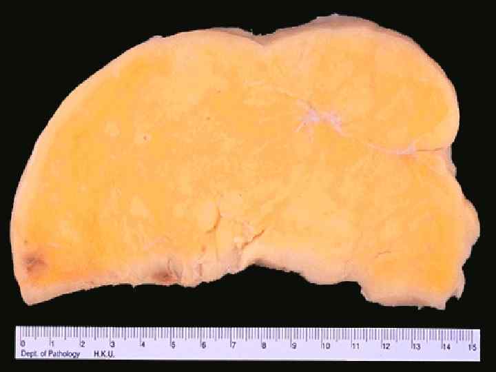This large mass lesion is a liposarcoma. Common sites are the retroperitoneum and thigh,