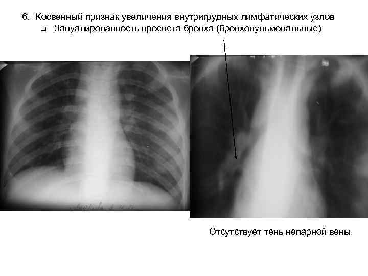 6. Косвенный признак увеличения внутригрудных лимфатических узлов q Завуалированность просвета бронха (бронхопульмональные) Отсутствует тень