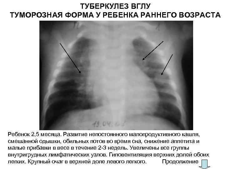 ТУБЕРКУЛЕЗ ВГЛУ ТУМОРОЗНАЯ ФОРМА У РЕБЕНКА РАННЕГО ВОЗРАСТА Ребенок 2, 5 месяца. Развитие непостоянного