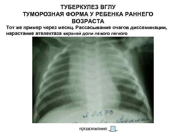 ТУБЕРКУЛЕЗ ВГЛУ ТУМОРОЗНАЯ ФОРМА У РЕБЕНКА РАННЕГО ВОЗРАСТА Тот же пример через месяц. Рассасывание