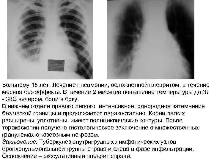 Больному 15 лет. Лечение пневмонии, осложненной плевритом, в течение месяца без эффекта. В течение
