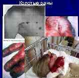 Колотые раны 