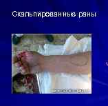 Скальпированные раны 