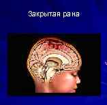 Закрытая рана 