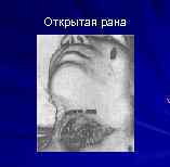 Открытая рана 