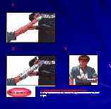 1 2 3 В случае травматической ампутации кисти? Следует обязательно наложить кровоостанавливающий жгут. 