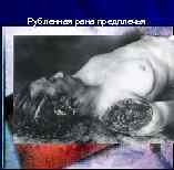 Рубленная рана предплечья 