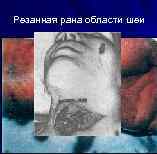 Резанная рана области шеи 