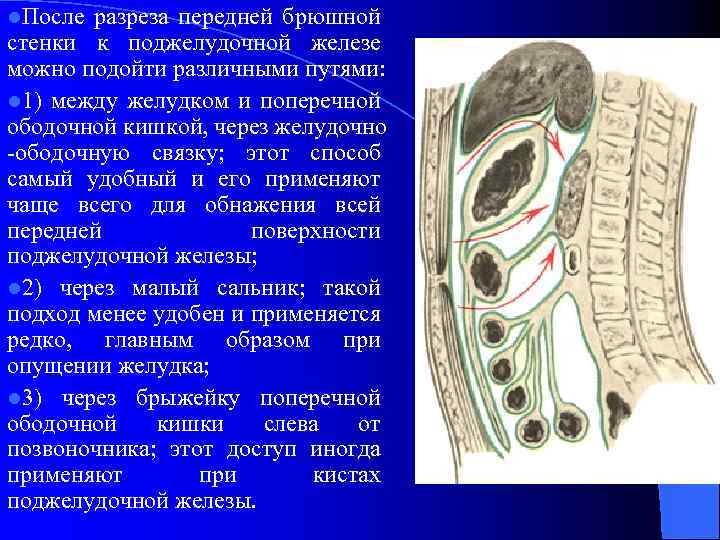 l. После разреза передней брюшной стенки к поджелудочной железе можно подойти различными путями: l