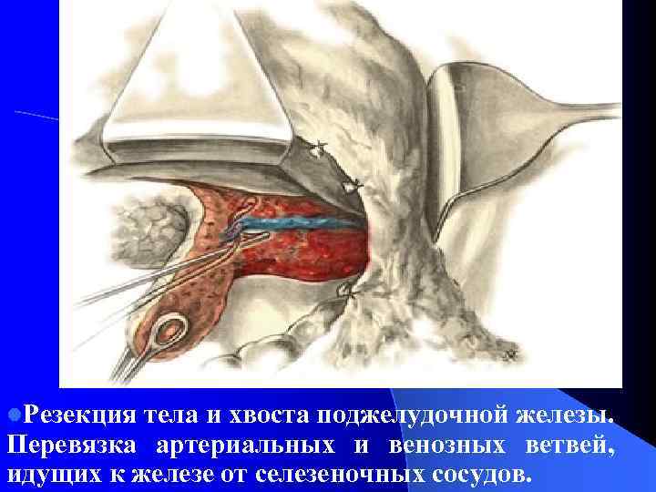 l. Резекция тела и хвоста поджелудочной железы. Перевязка артериальных и венозных ветвей, идущих к