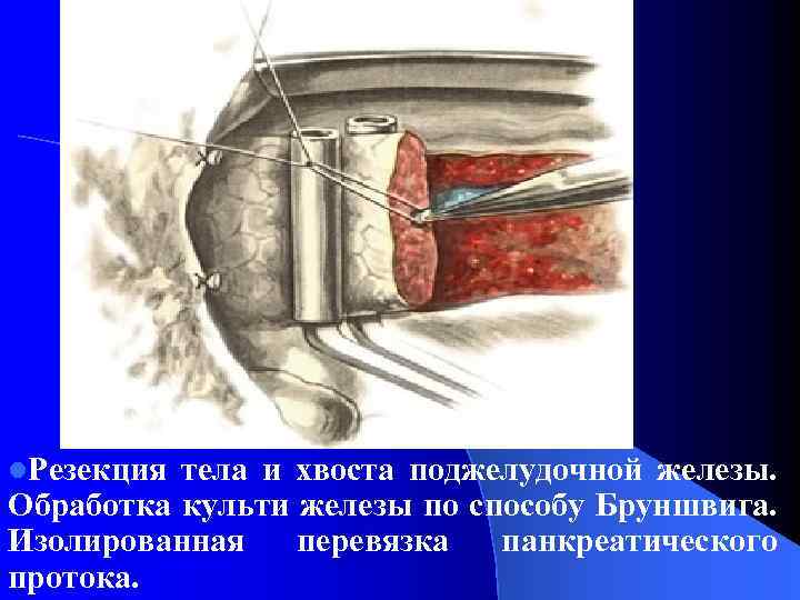 l. Резекция тела и хвоста поджелудочной железы. Обработка культи железы по способу Бруншвига. Изолированная