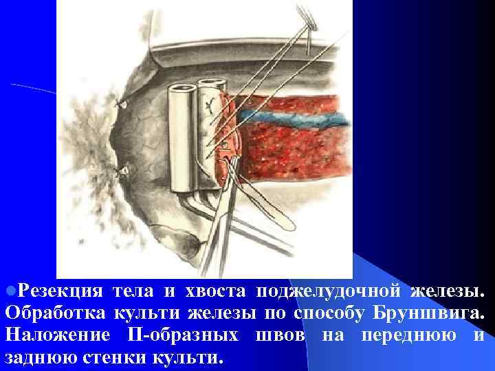 l. Резекция тела и хвоста поджелудочной железы. Обработка культи железы по способу Бруншвига. Наложение