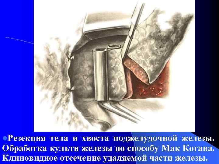 l. Резекция тела и хвоста поджелудочной железы. Обработка культи железы по способу Мак Когана.