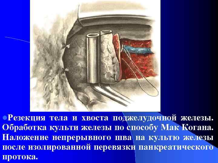 l. Резекция тела и хвоста поджелудочной железы. Обработка культи железы по способу Мак Когана.