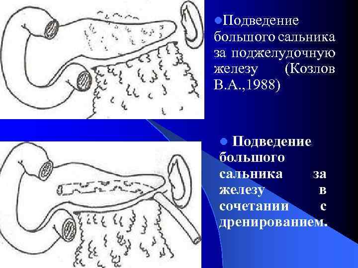 l. Подведение большого сальника за поджелудочную железу (Козлов В. А. , 1988) l Подведение