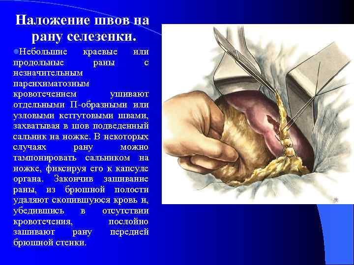 Наложение швов на рану селезенки. l. Небольшие краевые или продольные раны с незначительным паренхиматозным