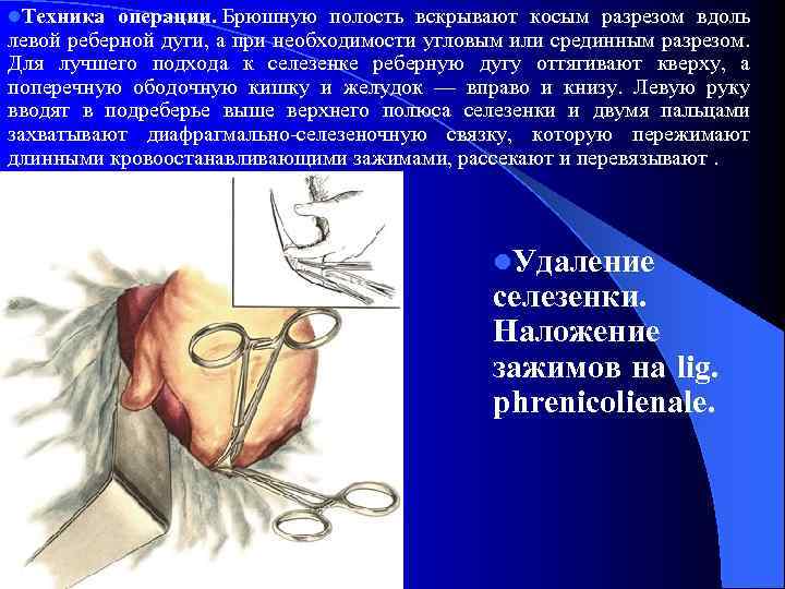 l. Техника операции. Брюшную полость вскрывают косым разрезом вдоль левой реберной дуги, а при