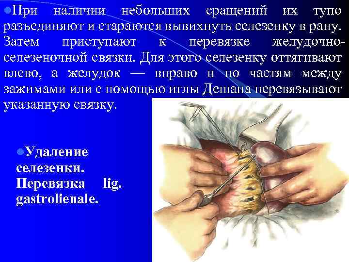 l. При наличии небольших сращений их тупо разъединяют и стараются вывихнуть селезенку в рану.