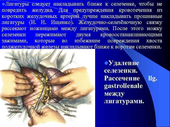 l. Лигатуры следует накладывать ближе к селезенке, чтобы не повредить желудка. Для предупреждения кровотечения