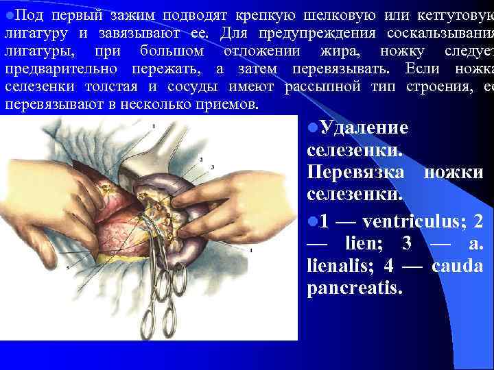 l. Под первый зажим подводят крепкую шелковую или кетгутовую лигатуру и завязывают ее. Для