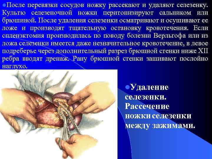 l. После перевязки сосудов ножку рассекают и удаляют селезенку. Культю селезеночной ножки перитонизируют сальником