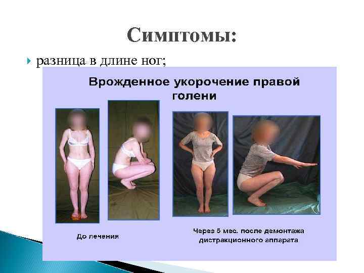 Симптомы: разница в длине ног; 