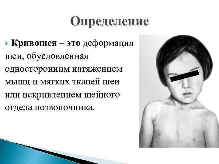 Определение Кривошея – это деформация шеи, обусловленная односторонним натяжением мышц и мягких тканей шеи