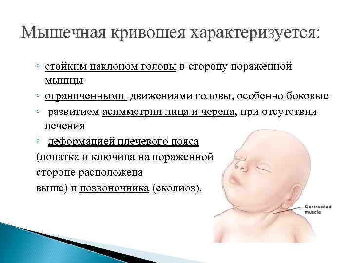 Кривошея у новорожденных фото лечение