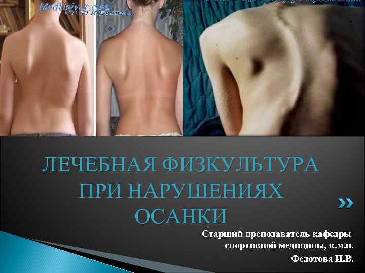ЛЕЧЕБНАЯ ФИЗКУЛЬТУРА ПРИ НАРУШЕНИЯХ ОСАНКИ Старший преподаватель кафедры спортивной медицины, к. м. н. Федотова