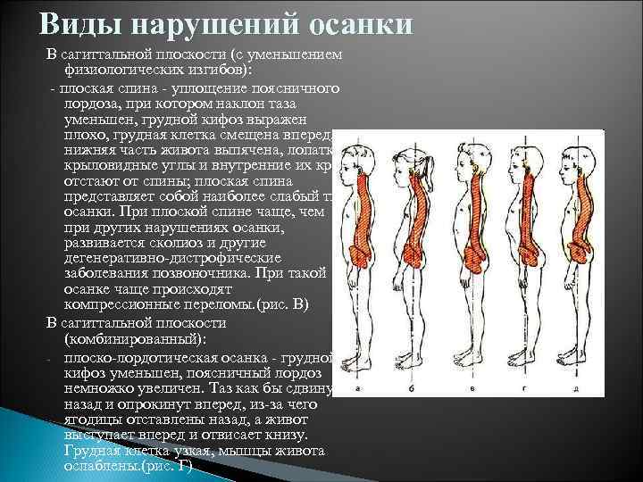 Нарушаемая вид. Виды нарушения осанки в сагиттальной плоскости. Тип осанки сагиттальная плоскость. Нарушение осанки в сагиттальной. Дефекты осанки в сагиттальной плоскости.