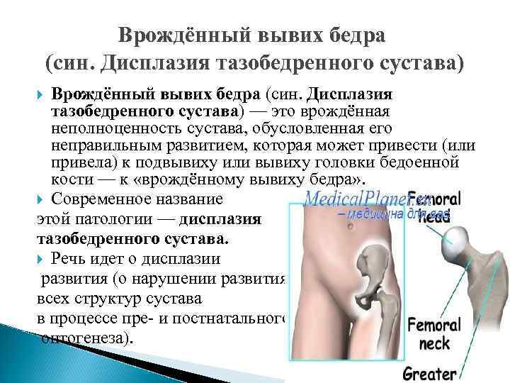 Врождённый вывих бедра (син. Дисплазия тазобедренного сустава) — это врождённая неполноценность сустава, обусловленная его