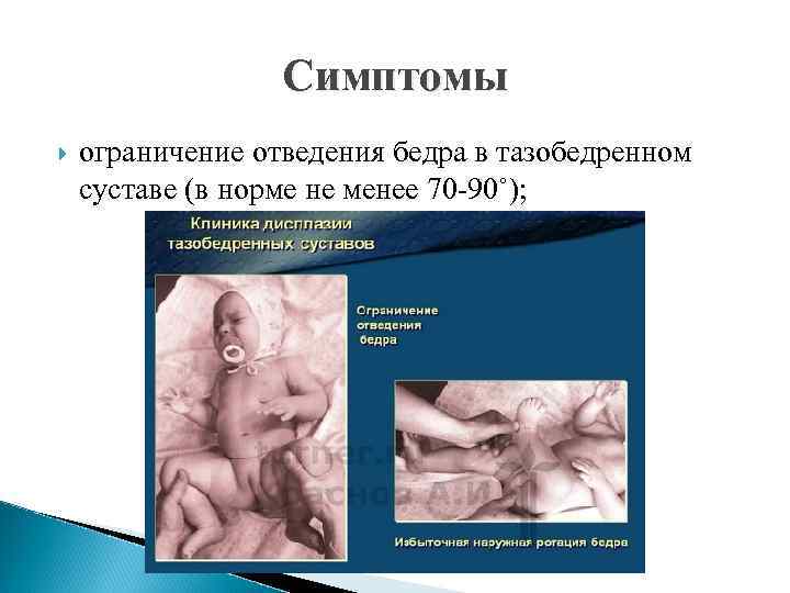 Симптомы ограничение отведения бедра в тазобедренном суставе (в норме не менее 70 -90˚); 