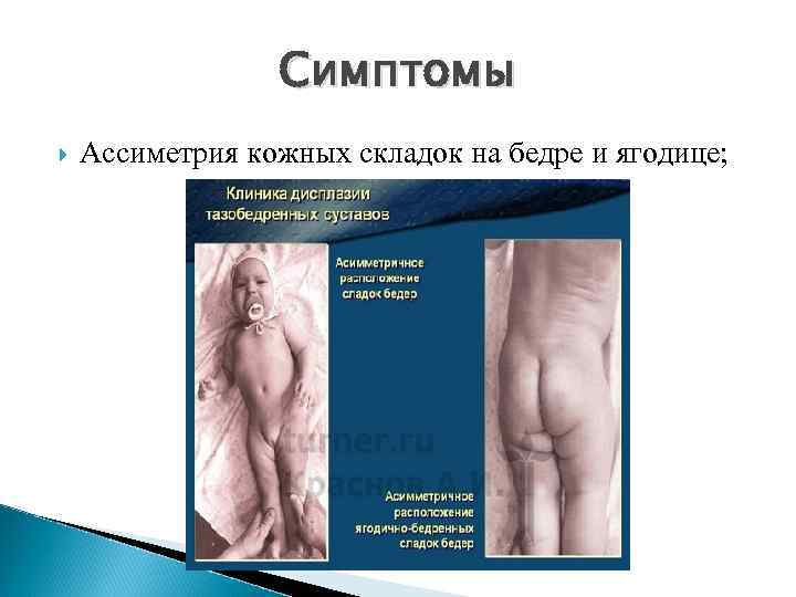 Симптомы Ассиметрия кожных складок на бедре и ягодице; 