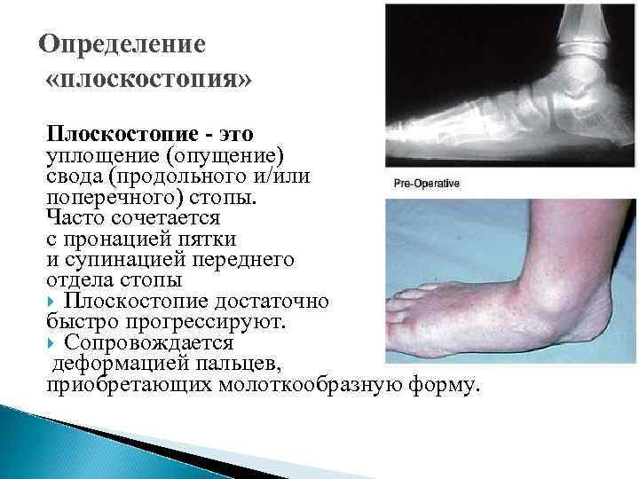 Определение «плоскостопия» Плоскостопие - это уплощение (опущение) свода (продольного и/или поперечного) стопы. Часто сочетается