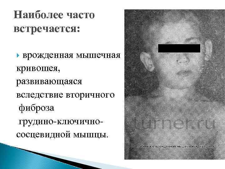 Наиболее часто встречается: врожденная мышечная кривошея, развивающаяся вследствие вторичного фиброза грудино-ключичнососцевидной мышцы. 