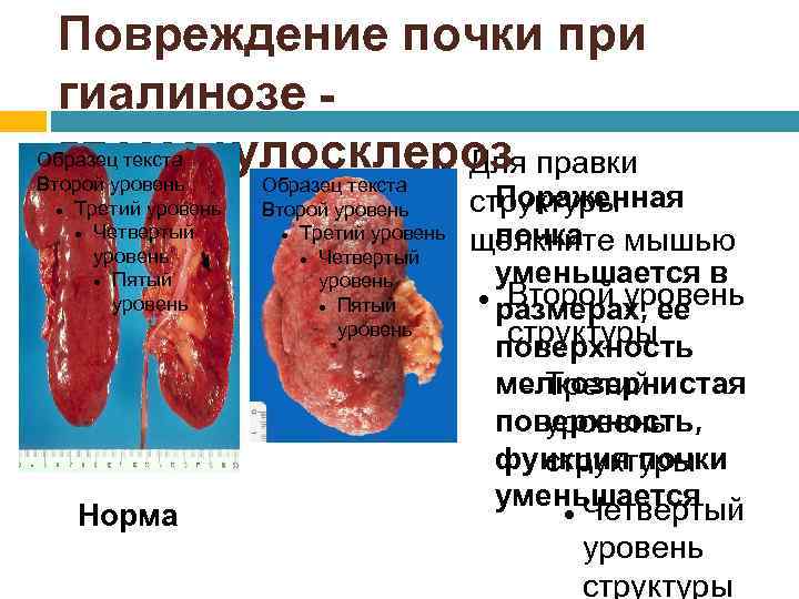 Повреждение почки при гиалинозе Образец текста гломерулосклероз правки Для Второй уровень Третий уровень Четвертый