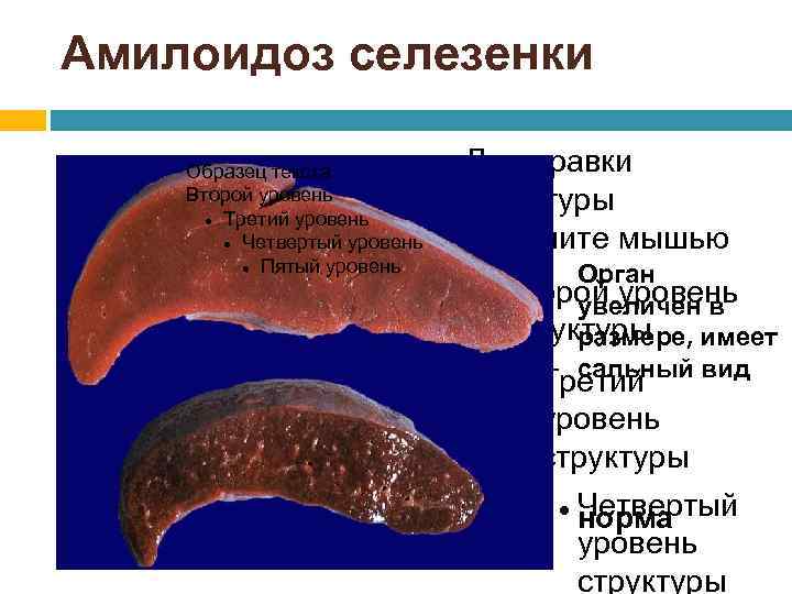 Амилоидоз селезенки Образец текста Второй уровень Третий уровень Четвертый уровень Пятый уровень Для правки