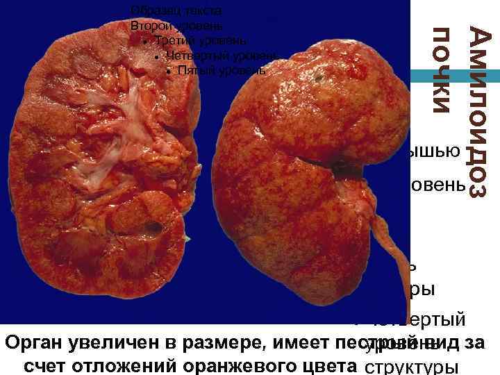  Амилоидоз почки Образец текста Второй уровень Третий уровень Четвертый уровень Пятый уровень Для