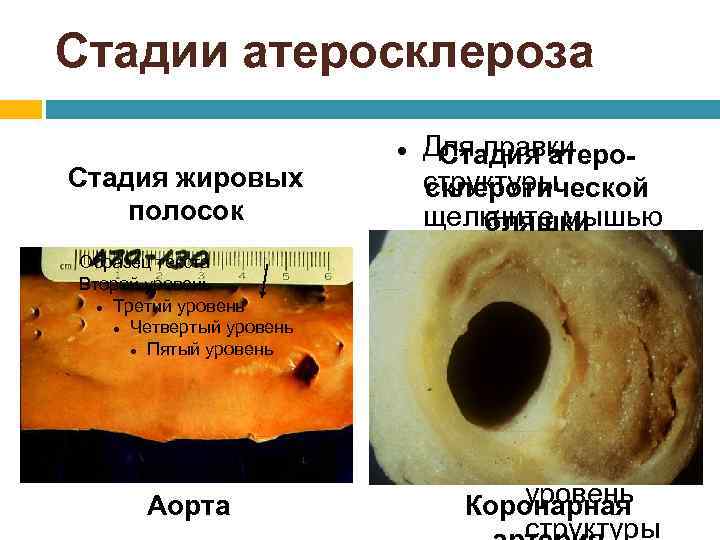 Стадии атеросклероза Стадия жировых полосок Образец текста Второй уровень Третий уровень Четвертый уровень Пятый