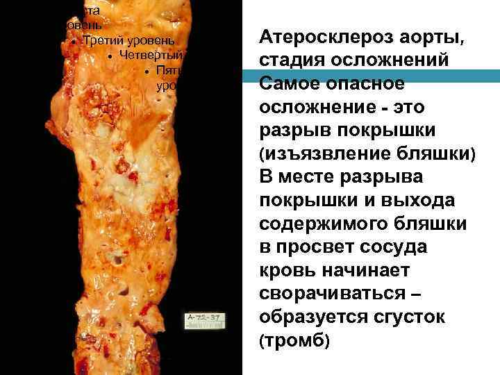 Образец текста Второй уровень Третий уровень Четвертый уровень Пятый уровень Атеросклероз аорты, стадия осложнений