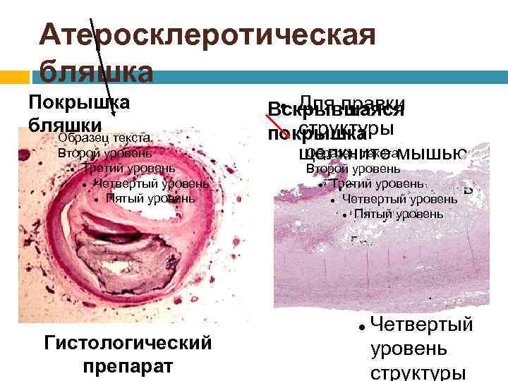 Атеросклеротическая бляшка Покрышка бляшки текста Образец Второй уровень Третий уровень Четвертый уровень Пятый уровень